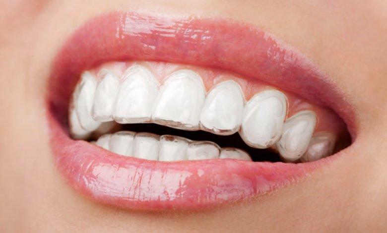 invisalign smile