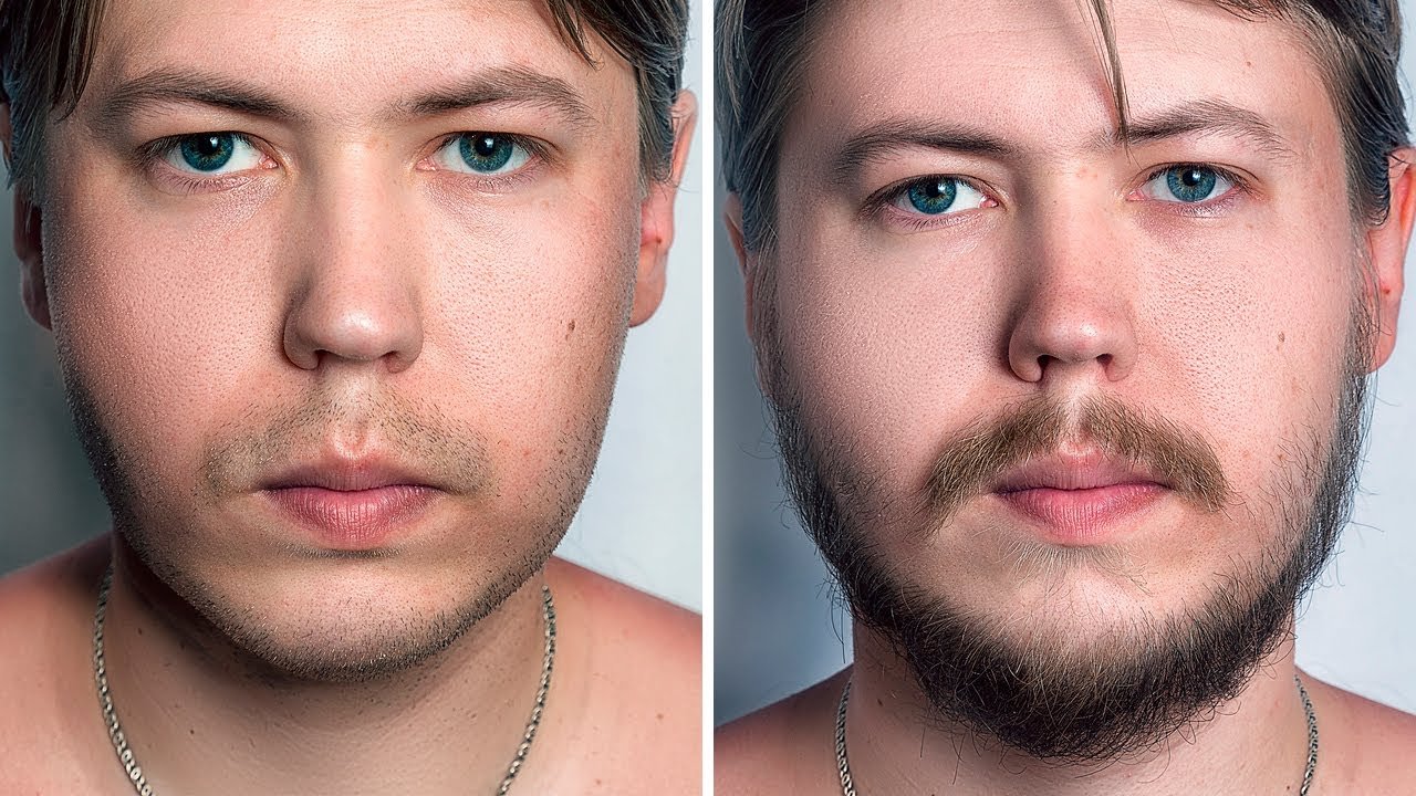 Facial Hair Transplant Procedure, Benefits, And Its Healing Time
