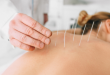 Acupuncture for pain relief